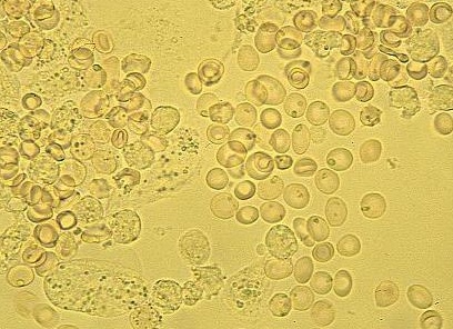 Почему повышены лейкоциты в моче при беременности, как их нормализовать