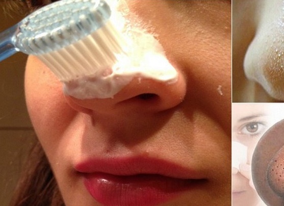 Как быстро избавиться от черных точек в домашних условиях