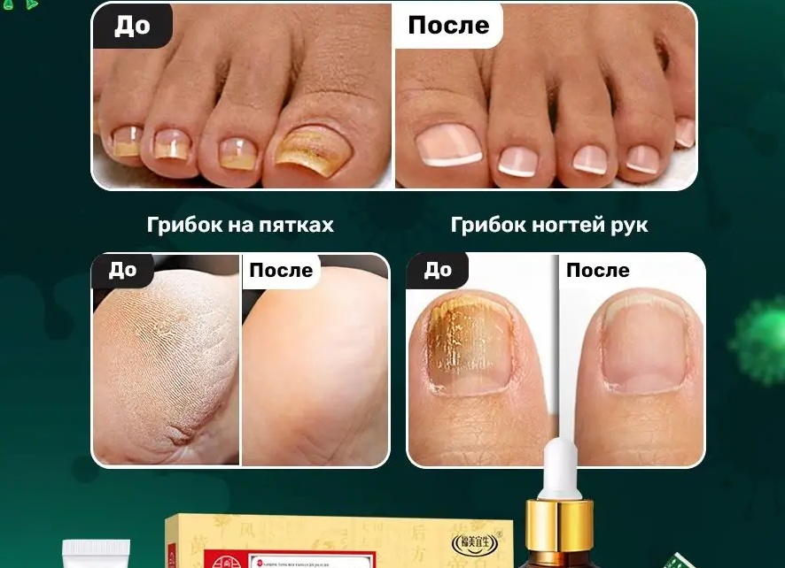 Чем лечить грибок ногтей на ногах в домашних условиях