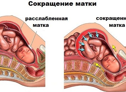 Как снять гипертонус матки при беременности Как снять гипертонус матки при беременности