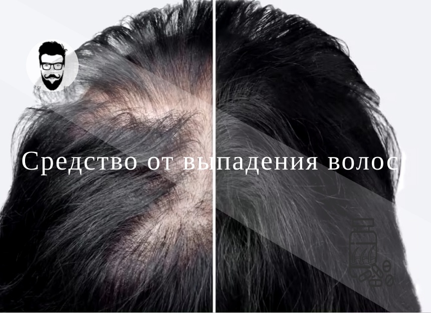 ТОП средств от облысения у мужчин