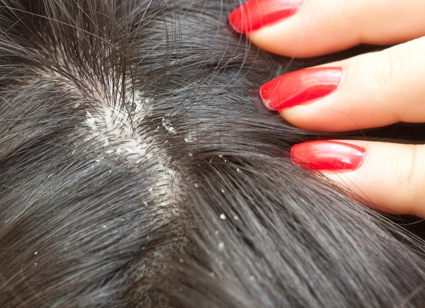 Как быстро избавиться от перхоти в домашних условиях Как быстро избавиться от перхоти в домашних условиях