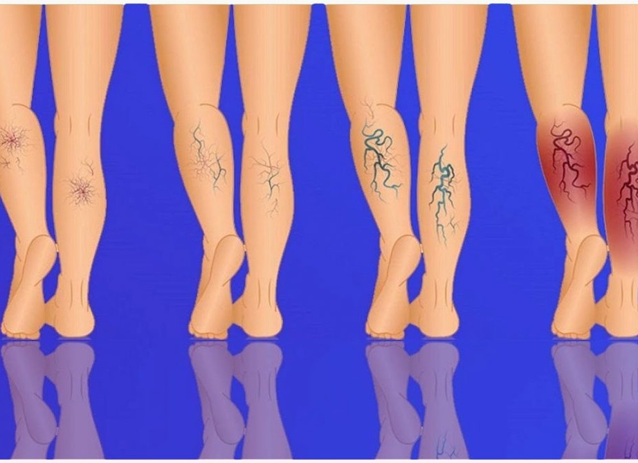 Средства от варикоза вен на ногах и методы лечения