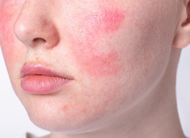 Почему возникают красные пятна на лице и как от них избавиться
