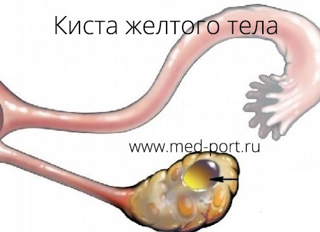 Причины появления и лечение кисты желтого тела на правом и левом яичниках