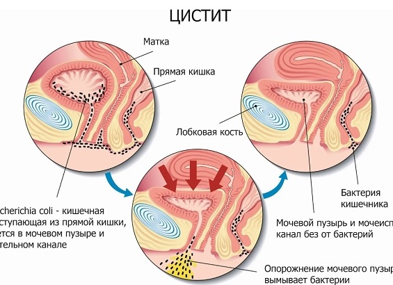 Как проявляется и лечится цистит у мужчин