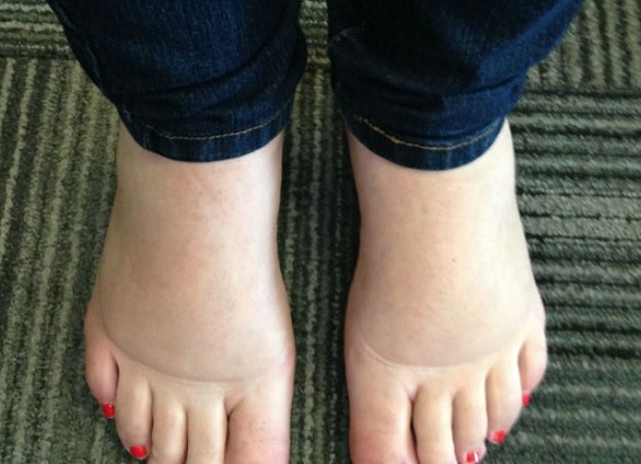 Как снять отеки во время беременности в домашних условиях