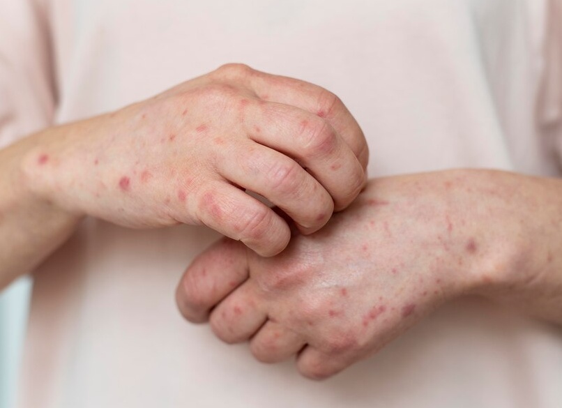 Симптомы и особенности лечения ветрянки у взрослого человека