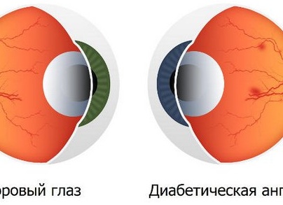 Что такое ангиопатия сетчатки глаза, чем ее можно лечить Что такое ангиопатия сетчатки глаза, чем ее можно лечить