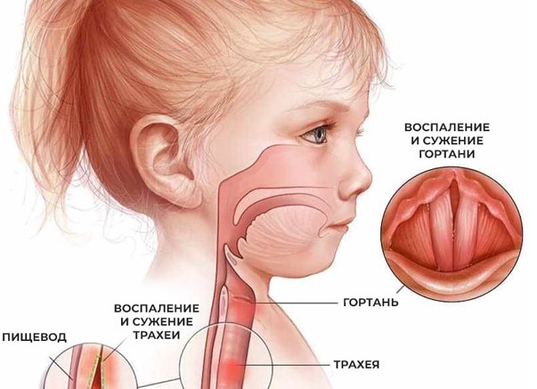 Причины, симптомы и лечение ларинготрахеита у детей Причины, симптомы и лечение ларинготрахеита у детей