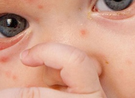 Как проявляется ветрянка у детей на начальной стадии