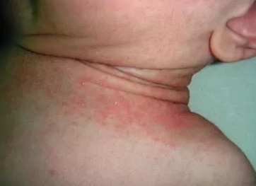 Чем лечить потницу у маленького ребенка