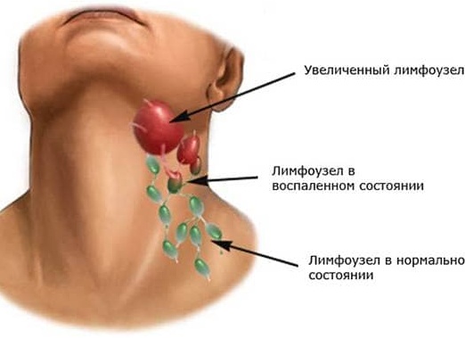 Как лечить лимфоузлы на шее у ребенка и взрослого человека