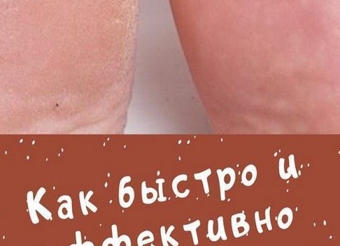 Как быстро избавиться от натоптышей на ступнях