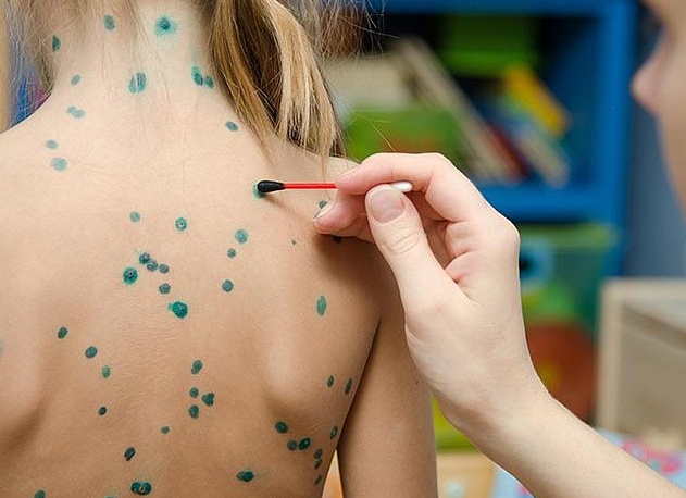 Сколько длится инкубационный период ветрянки у детей, как лечить заболевание