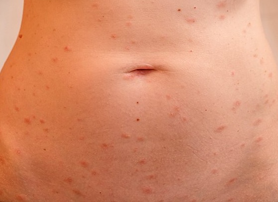 Как выглядит лишай на теле человека: фото, виды и симптомы