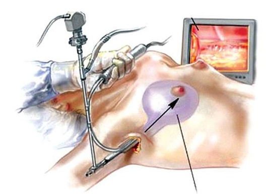 Как проводится операция по увеличению груди, сколько она стоит Как проводится операция по увеличению груди, сколько она стоит