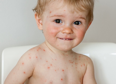 Ветряная оспа у детей: симптомы, лечение и меры профилактики Ветряная оспа у детей: симптомы, лечение и меры профилактики