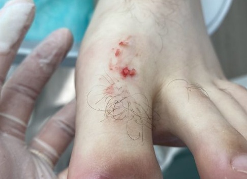 Причины и методы лечения вросшего ногтя на ноге