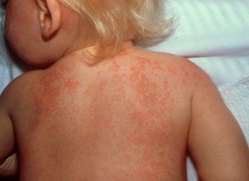 Как проявляется и лечится скарлатина у детей