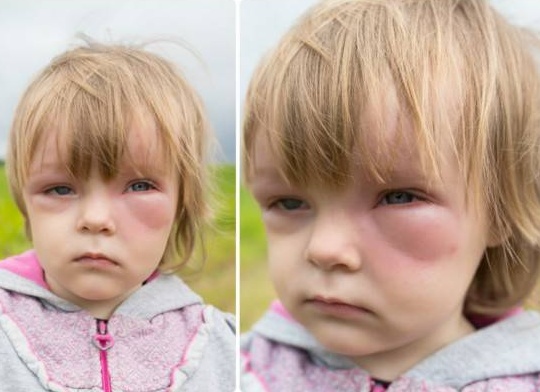 Почему у ребенка опухают глаза и что с этим делать