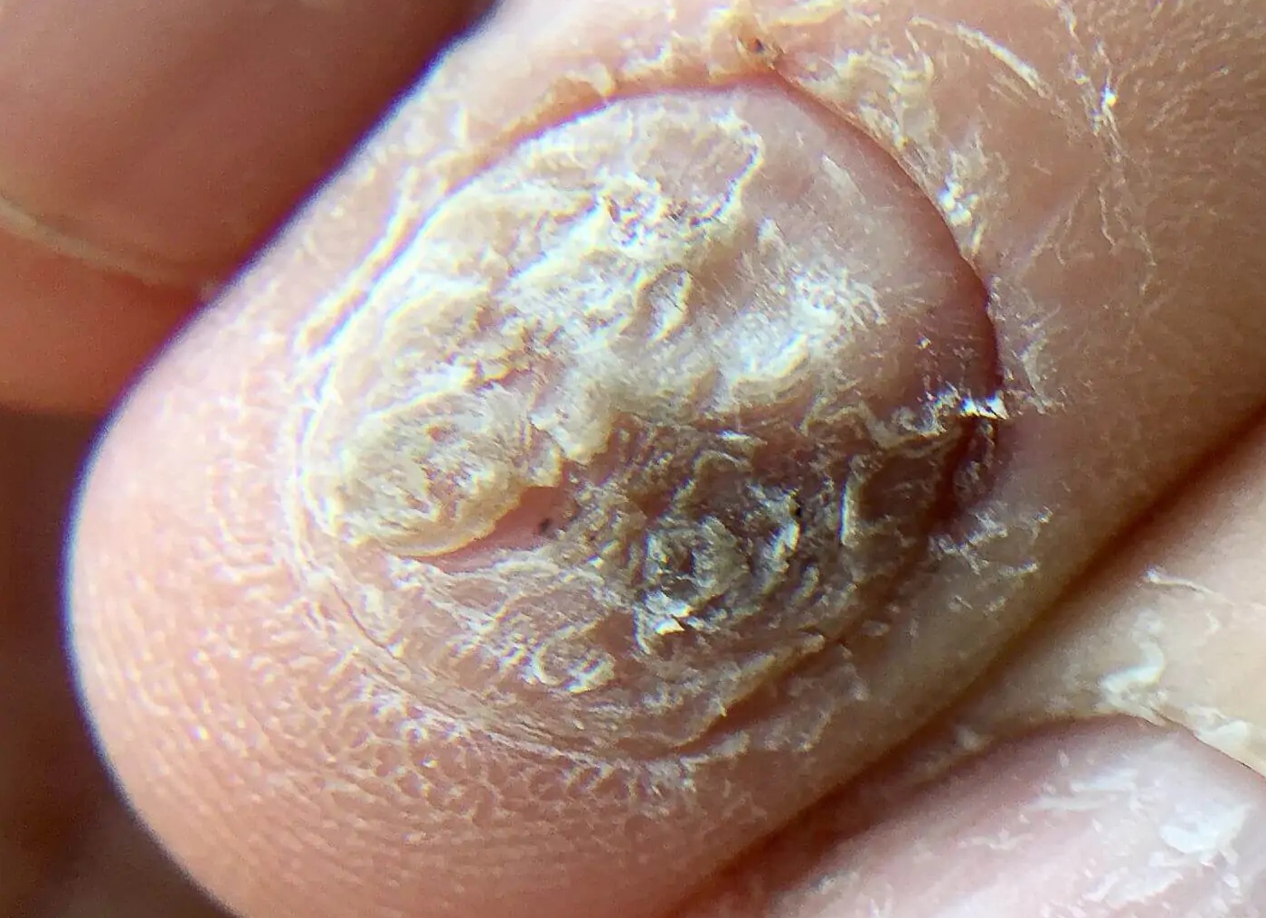 Лечение грибка ногтей на руках различными методами и народными средствами Лечение грибка ногтей на руках различными методами и народными средствами