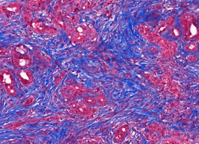 Что такое фиброз легких, поджелудочной железы, печени Что такое фиброз легких, поджелудочной железы, печени