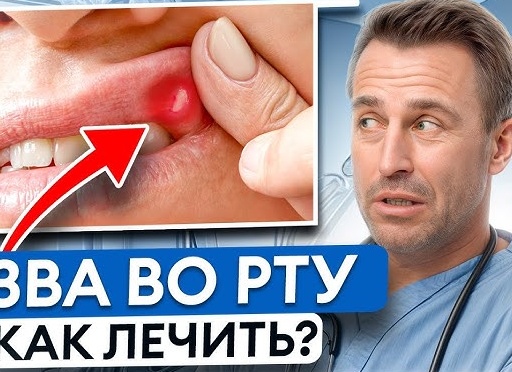 Как правильно лечить стоматит во рту у ребенка