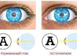 Что такое астигматизм глаз, как лечить заболевание Что такое астигматизм глаз, как лечить заболевание