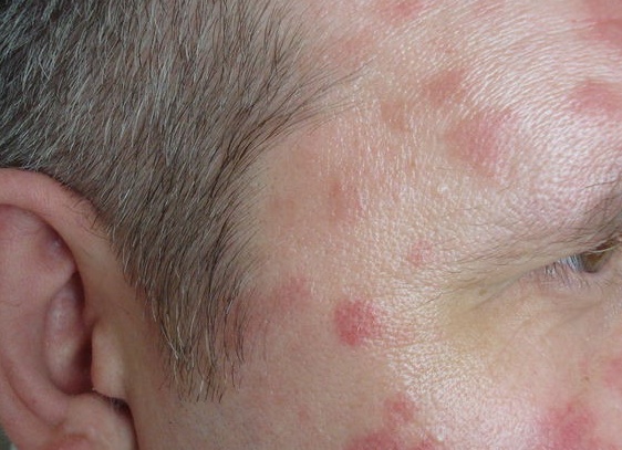 Как выглядит псориаз на лице и как эффективно его лечить