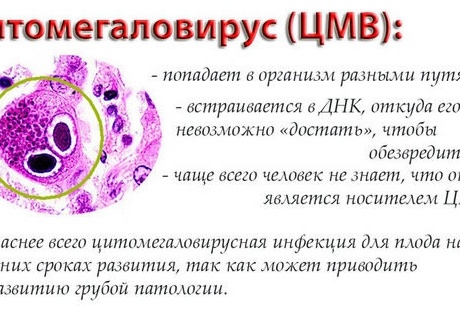 Что такое цитомегаловирус и как лечить заболевание?