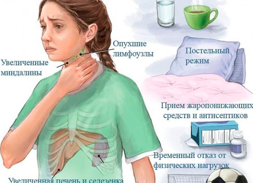 Симптомы и лечение инфекционного мононуклеоза у детей
