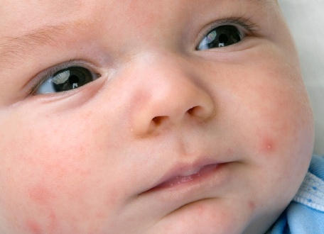 Как проявляется аллергия у грудничка и что делать при первых симптомах