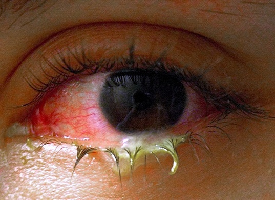 Что делать, если гноятся глаза у ребенка Что делать, если гноятся глаза у ребенка