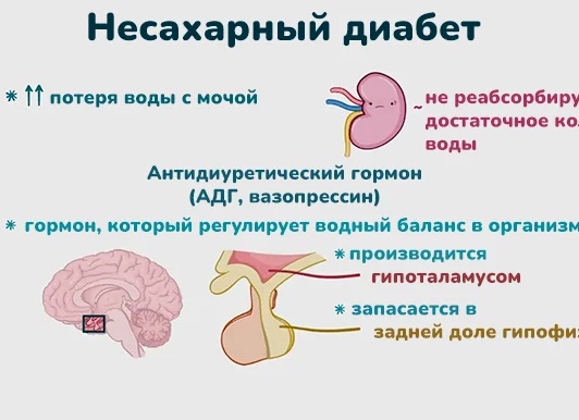 Несахарный диабет: симптомы и лечение