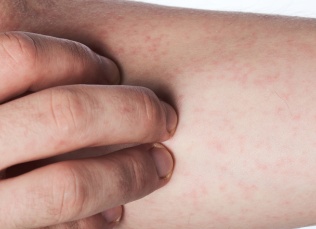 Васкулит: что это за болезнь и как ее лечить