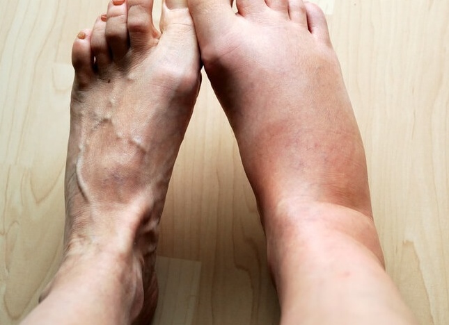 Отекают ноги: причины, что делать, лечение в домашних условиях Отекают ноги: причины, что делать, лечение в домашних условиях