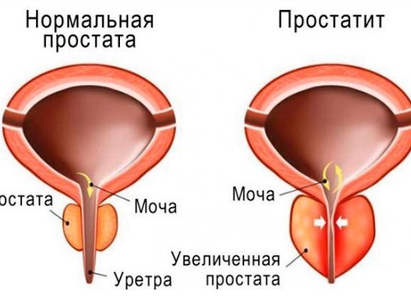 Антибиотики при остром и хроническом простатите Антибиотики при остром и хроническом простатите