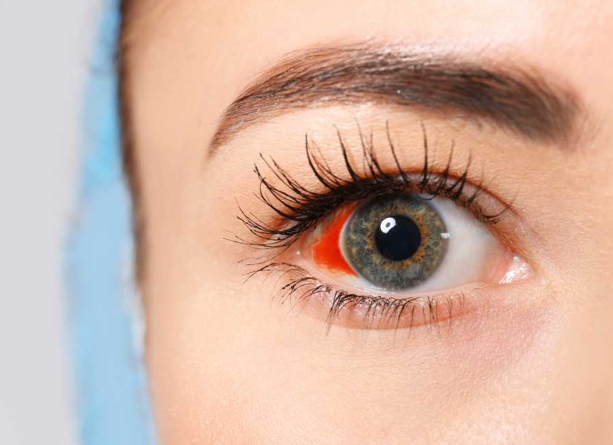 Лопнул сосуд в глазу: причины, борьба с последствиями и последующее лечение
