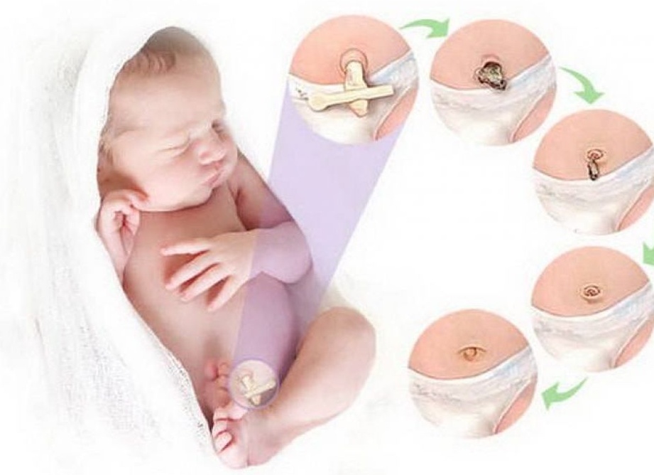 Правильная обработка пупка у новорожденного ребенка Правильная обработка пупка у новорожденного ребенка