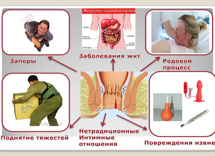 Как лечить трещину заднего прохода у ребенка и взрослого