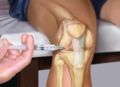Как можно вылечить артроз коленного сустава