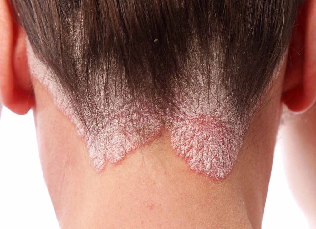 Как вылечить псориаз на голове в домашних условиях Как вылечить псориаз на голове в домашних условиях