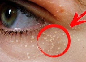 Почему появляются жировики на лице и как от них избавиться