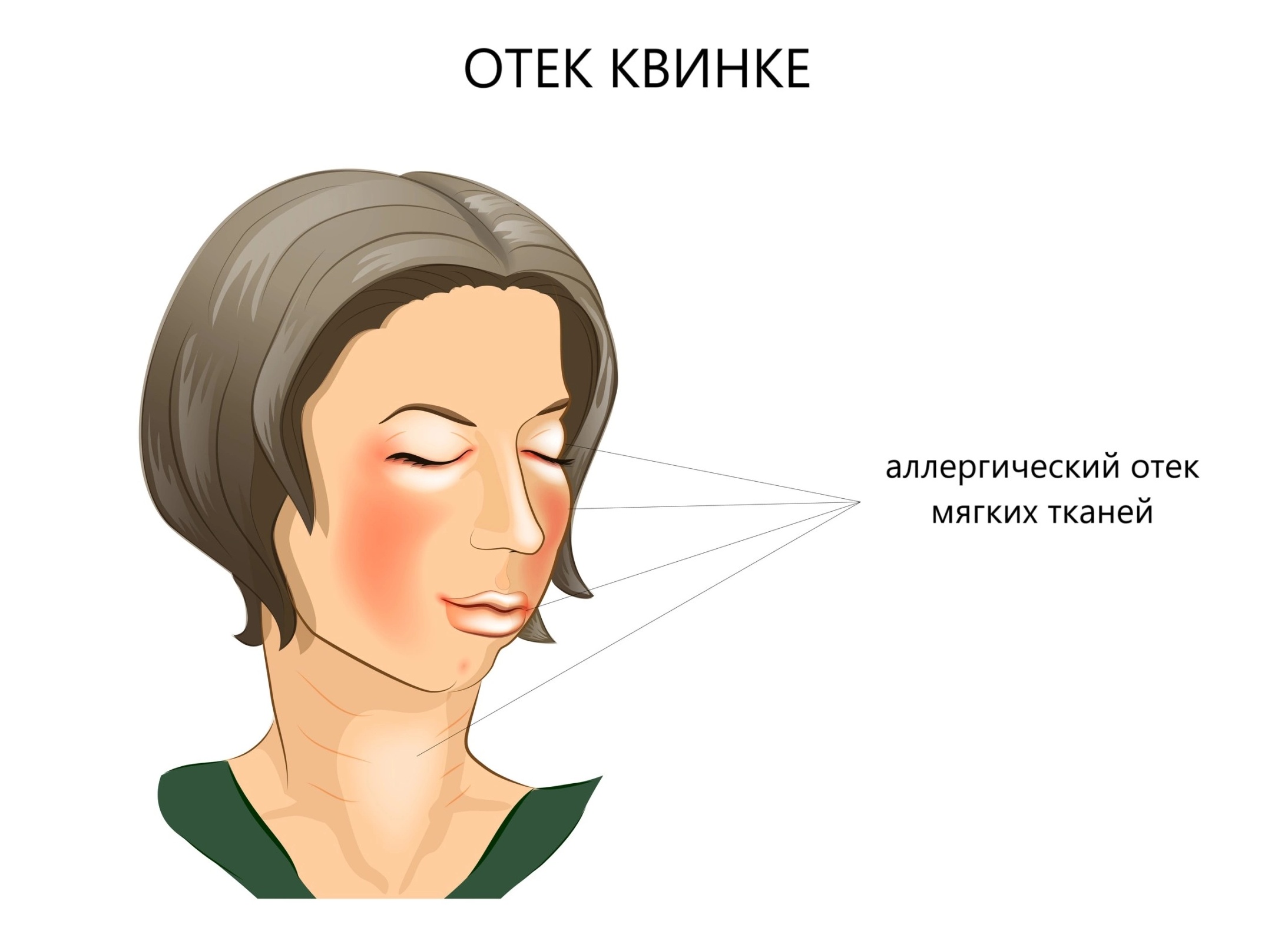 Что делать, если опухли глаза: первая помощь в домашних условиях