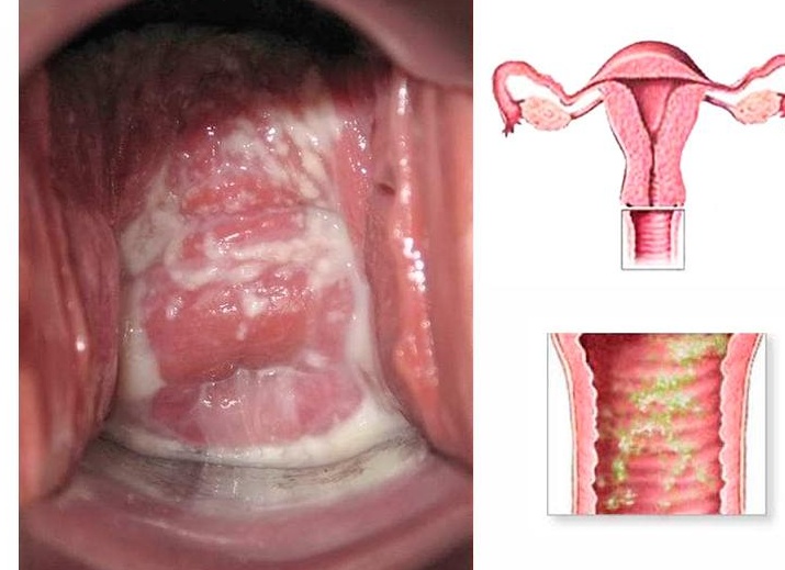 Кольпит: что это такое и как с ним бороться