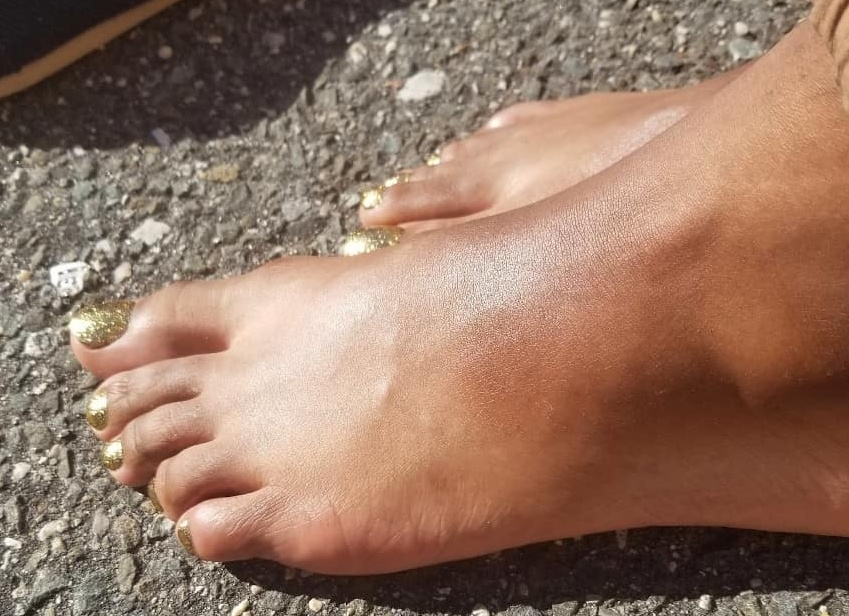 Как снять отек ног в области стопы Как снять отек ног в области стопы