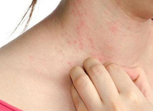 Симптомы и лечение нейродермита у взрослых и детей