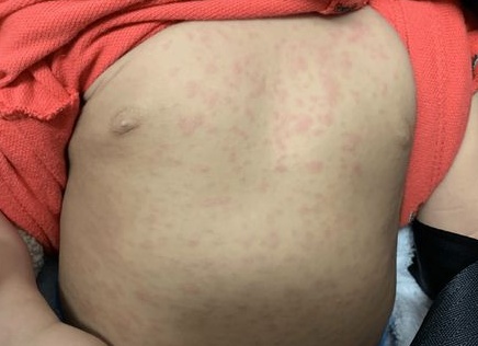 Способы лечения розеолы у детей, осложнения и профилактика Способы лечения розеолы у детей, осложнения и профилактика