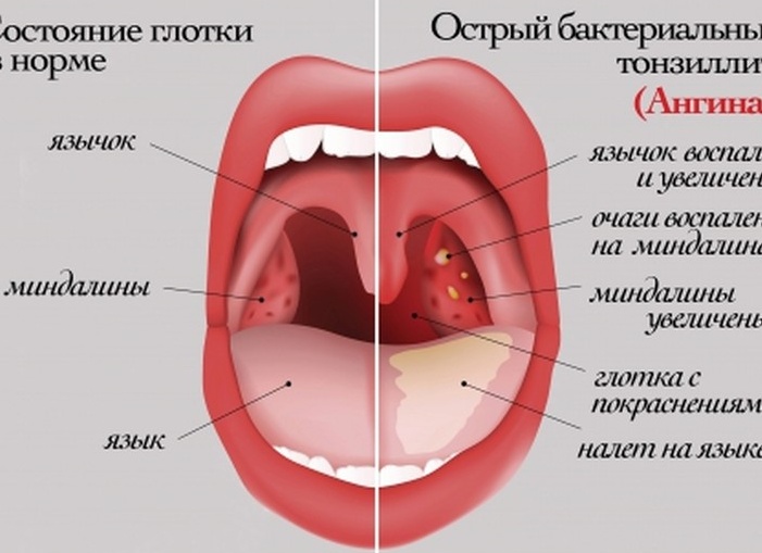 Симптомы и лечение герпетической ангины у детей